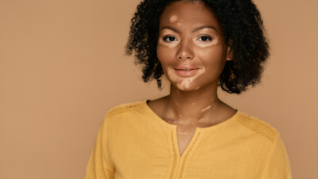 Melanin & Misdiagnoses: The Hidden Struggles Of Psoriasis In People Of Color